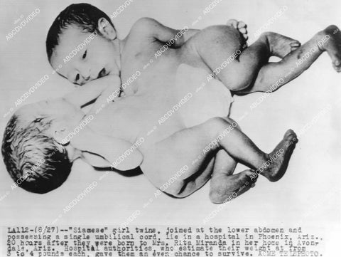 crp-12048 1950's news photo medical news Siamese twin girls born to Rita Miranda Avondal Ariz crp-12048